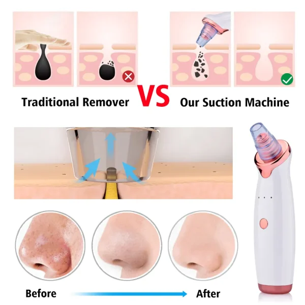 vacuum-blackhead-remover-face-black-spots-cleaner-white-dot-pimple-removal – 5